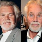 kennyrogers-beforeafter