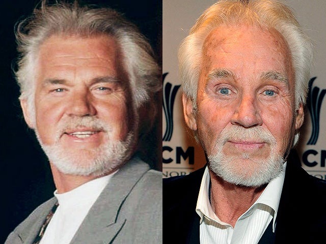 kennyrogers-beforeafter